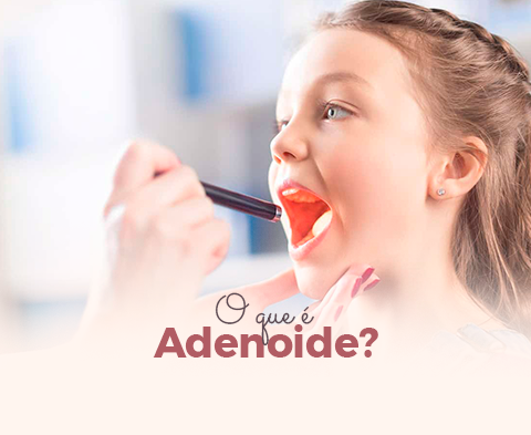 O que é Adenoide?